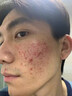 MOIHANR德國進(jìn)口原料氨基酸祛痘洗面奶控油除螨蟲去黑頭縮毛孔男女專用 【祛痘除螨控油】兩瓶裝 曬單實(shí)拍圖
