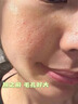 醫(yī)用精華液械字號(hào)收縮毛孔粗大修復(fù)細(xì)致去黑頭粉刺閉口男士女士祛痘印黑色素沉淀控油淡化痘印痘坑透明質(zhì)酸鈉 曬單實(shí)拍圖