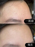 醫(yī)用精華液械字號收縮毛孔粗大修復(fù)細(xì)致去黑頭粉刺閉口男士女士祛痘印黑色素沉淀控油淡化痘印痘坑透明質(zhì)酸鈉 曬單實拍圖