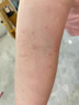 兒童傳染性軟疣膏病毒性水猴子可搭專(zhuān)用去刮疣工具醫用級小兒成人軟疣去除神器GU 單盒體驗裝 曬單實(shí)拍圖