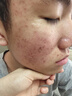 普門(mén)科技醫用大排燈美容儀紅藍黃光治療敏感肌痘痘痤瘡濕疹消炎禮物送女友 光E醫用升級版+送旅行面罩大排燈+語(yǔ)音聲控 曬單實(shí)拍圖
