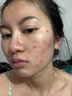VERZXMERY 御宅鮮顏重組膠原蛋白冷敷貼面膜術(shù)后曬后敏感肌修護肌膚祛紅腫去痘痘肌女 御宅鮮顏重組膠原蛋白敷料 三盒15片 曬單實(shí)拍圖