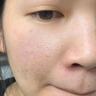 醫用精華液械字號收縮毛孔粗大修復細致去黑頭粉刺閉口男士女士祛痘印黑色素沉淀控油淡化痘印痘坑透明質(zhì)酸鈉 曬單實(shí)拍圖