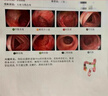 ASTACURE痔瘡膏痔瘡凝膠100%特效專(zhuān)用藥去肉球內外混合痔瘡去斷肉球神器根 曬單實(shí)拍圖