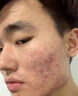 清熱暗瘡丸祛痘痘粉刺痘印醫用痤瘡中藥去青春痘紅腫硬疙瘩痘印消炎膿皰去痘印青少年痤瘡專(zhuān)用藥【視覺(jué)特效】 1盒【醫用祛痘藥】 曬單實(shí)拍圖