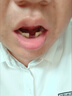 愛牙博士補(bǔ)牙齒神器材料永久自己在家補(bǔ)牙高硬度醫(yī)用進(jìn)口樹脂填充牙洞神器 【加強(qiáng)納米材料】5ML送 工具包 曬單實(shí)拍圖