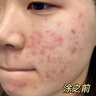 泊紫汀蘭祛痘膏祛痘淡化痘印消閉口修護痘痕痘坑去粉刺控油青春痘男女學(xué)生 曬單實(shí)拍圖