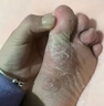 達克寧腳氣藥止癢脫皮爛腳丫真菌感染硝酸咪康唑乳膏治腳氣根專(zhuān)用特藥皮膚用藥 非處方藥腳臭腳趾縫起水泡瘙癢干裂 1盒【腳起水泡 癢的受不了】硝酸咪康唑乳膏 皮膚用藥 非處方藥達克寧腳氣藥止癢脫皮爛腳丫真菌 曬單實(shí)拍圖