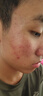 普門(mén)科技醫用大排燈美容儀紅藍黃光治療敏感肌痘痘痤瘡濕疹消炎禮物送女友 光E醫用升級版+送旅行面罩大排燈+語(yǔ)音聲控 曬單實(shí)拍圖