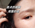 dyey祛痣點(diǎn)痣膏無(wú)痕臉部黑痣扁I平疣痦子瘊子祛斑點(diǎn)斑非薬水面部專(zhuān)用 曬單實(shí)拍圖