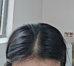 【第二代米諾地爾】蔓迪5%生發(fā)泡沫劑60g*3（倍速生發(fā) 溫和不起痘）男女士專(zhuān)用治脫發(fā)防脫育發(fā)米洛原液酊搽劑 曬單實(shí)拍圖