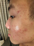 普門(mén)科技醫用大排燈美容儀紅藍黃光治療敏感肌痘痘痤瘡濕疹消炎禮物送女友 光E醫用升級版+送旅行面罩大排燈+語(yǔ)音聲控 曬單實(shí)拍圖