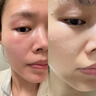 Newliann醫用械字號面膜冷敷貼醫美術(shù)后修復保濕補水激光修護祛痘痤瘡皮炎 曬單實(shí)拍圖