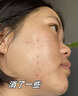 南京同仁堂祛痘膏去痘痘和痘印痘坑修復男女士改善粉刺閉口30g 曬單實(shí)拍圖