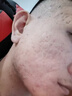 西摩 SKIN SMOOTH去痘祛痘祛痘印精華水修復滋養skinsmooth西摩祛痘水全新升級款 送消炎酊 曬單實(shí)拍圖