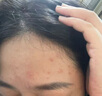 比度克祛痘膏祛痘淡化呵護男女青春痘清涼潤澤單只裝20g 曬單實拍圖