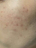 維特絲壬二酸祛痘藥膏煙酰胺凝膠去痘痘粉刺閉口男女水楊酸收毛孔青少年 曬單實拍圖
