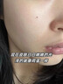 Newliann醫用祛痘印去黑色素沉淀去除膏痘痘貼和修復痘坑疤痕淡化青春痘 曬單實(shí)拍圖