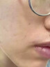 久卜制藥醫用痘痘貼消吸膿炎隱形輕薄祛痘人工皮修復淡化遮瑕貼108貼/盒 曬單實(shí)拍圖