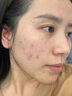 維特絲壬二酸祛痘藥膏煙酰胺凝膠去痘痘粉刺閉口男女水楊酸收毛孔青少年 曬單實(shí)拍圖