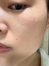 Newliann醫用械字號面膜冷敷貼醫美術(shù)后修復保濕補水激光修護祛痘痤瘡皮炎 曬單實(shí)拍圖