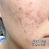 OHBT祛痘藥膏60g水楊酸祛痘淡化痘印痘坑凝膠青春痘學(xué)生青少年護膚品 曬單實(shí)拍圖