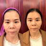 三型膠原蛋白改善太陽穴川字紋淚溝法令紋臉頰三線提升美院同款 曬單實拍圖