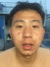 YYTISS祛痘淡化痘印去痘痘和痘印黑色素沉淀痘坑修疤復青春痘祛痘膏學生 曬單實拍圖