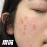 泊紫汀蘭祛痘膏祛痘淡化痘印消閉口修護痘痕痘坑去粉刺控油青春痘男女學(xué)生 曬單實(shí)拍圖