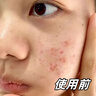 韓方五谷壬二酸祛痘膏膠態(tài)硫凝膠去痘痘淡印痘坑水楊酸祛痘青春期學(xué)生專(zhuān)用 曬單實(shí)拍圖