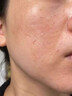 藤石制藥【醫用】痘坑修復凹洞生長(cháng)因子臉部用痘印痘疤修復凹洞填充再生BC 買(mǎi)二送一【療程裝】祛痘印痘坑凹洞修復再生+棉簽*1 曬單實(shí)拍圖
