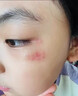 內廷上用祛疤膏痕剖腹產(chǎn)去疤藥膏手術(shù)疤痕縫針術(shù)后修復除疤醫用硅酮凝膠 1支裝【1年以?xún)劝毯劭捎谩啃∶娣e 【增生凸起去除疙瘩】 曬單實(shí)拍圖