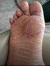 CNDK足部真菌王腳氣腳癢水泡脫皮腳臭香港腳腳汗爛腳丫真菌感染止癢膏 濃度999+【強效款嚴重腳氣】 曬單實(shí)拍圖