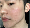 醫用精華液械字號收縮毛孔粗大修復細致去黑頭粉刺閉口男士女士祛痘印黑色素沉淀控油淡化痘印痘坑透明質(zhì)酸鈉 曬單實(shí)拍圖