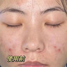 Newliann醫用祛痘貼去痘痘和痘印消炎吸膿隱形修復膏淡化痘坑痤瘡專(zhuān)用制藥 曬單實(shí)拍圖