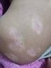 邦臣（BANGCHEN）308白癜風(fēng)治療儀光療儀家用醫院紫外線(xiàn)燈同款銀屑病窄譜nbuvb激光 【強度25/面積4】溫和款UV308B1 曬單實(shí)拍圖