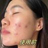 Newliann醫用祛痘貼去痘痘和痘印消炎吸膿隱形修復膏淡化痘坑痤瘡專(zhuān)用制藥 曬單實(shí)拍圖