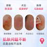 超亞醫用重組Ⅲ型人源化膠原蛋白修復術(shù)后修護保濕冷敷貼補水貼5片 曬單實(shí)拍圖