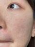 醫用精華液械字號收縮毛孔粗大修復細致去黑頭粉刺閉口男士女士祛痘印黑色素沉淀控油淡化痘印痘坑透明質(zhì)酸鈉 曬單實(shí)拍圖