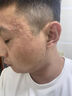 DR.AVIN【德國品牌】醫用痘坑修復凹洞填充再生長(cháng)因子祛痘印淡化修復男BD 送醫用棉簽【買(mǎi)三送二】鞏固裝（大面積痘印痘坑） 曬單實(shí)拍圖