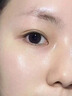 醫(yī)用精華液械字號(hào)收縮毛孔粗大修復(fù)細(xì)致去黑頭粉刺閉口男士女士祛痘印黑色素沉淀控油淡化痘印痘坑透明質(zhì)酸鈉 曬單實(shí)拍圖
