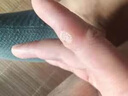 猴子去除藥膏刺猴專(zhuān)用的藥刺猴子尋常疣魚(yú)鱗痣跖疣專(zhuān)用藥腳底趾疣根肉粒疙瘩去疣瘊子特治療效藥 水楊酸軟膏 一盒【肉粒刺猴疙瘩去除疣瘊】 曬單實(shí)拍圖