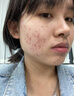 維特絲壬二酸祛痘藥膏煙酰胺凝膠去痘痘粉刺閉口男女水楊酸收毛孔青少年 曬單實(shí)拍圖