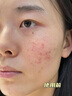 川廿制藥?kù)疃凰幐嗟挥∠尊畀弻Ｓ萌ザ欢挥⌒迯?fù)后背部學(xué)生青春痘凝膠 曬單實(shí)拍圖