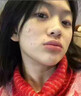 Newliann醫用祛痘貼去痘痘和痘印消炎吸膿隱形修復膏淡化痘坑痤瘡專(zhuān)用制藥 曬單實(shí)拍圖