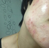 YYTISS祛痘藥膏淡化痘印消除坑炎痤瘡專(zhuān)用青少年去痘痘和痘印青春痘學(xué)生 曬單實(shí)拍圖