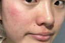 MOIHANR德國面膜醫用械字號冷敷貼醫美術(shù)后修復保濕補水曬后修復敏感皮膚 【術(shù)后修復補水】三盒裝 曬單實(shí)拍圖