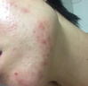 YYTISS祛痘藥膏淡化痘印消除坑炎痤瘡專(zhuān)用青少年去痘痘和痘印青春痘學(xué)生 曬單實(shí)拍圖