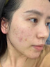 維特絲壬二酸祛痘藥膏煙酰胺凝膠去痘痘粉刺閉口男女水楊酸收毛孔青少年 曬單實(shí)拍圖