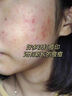 OURHEAL美國祛痘精華液淡化痘印修復消除痘印坑去痘痘消炎痤瘡專(zhuān)用青少年 曬單實(shí)拍圖